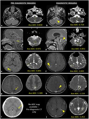 Characterization of pediatric brain tumors using pre-diagnostic neuroimaging